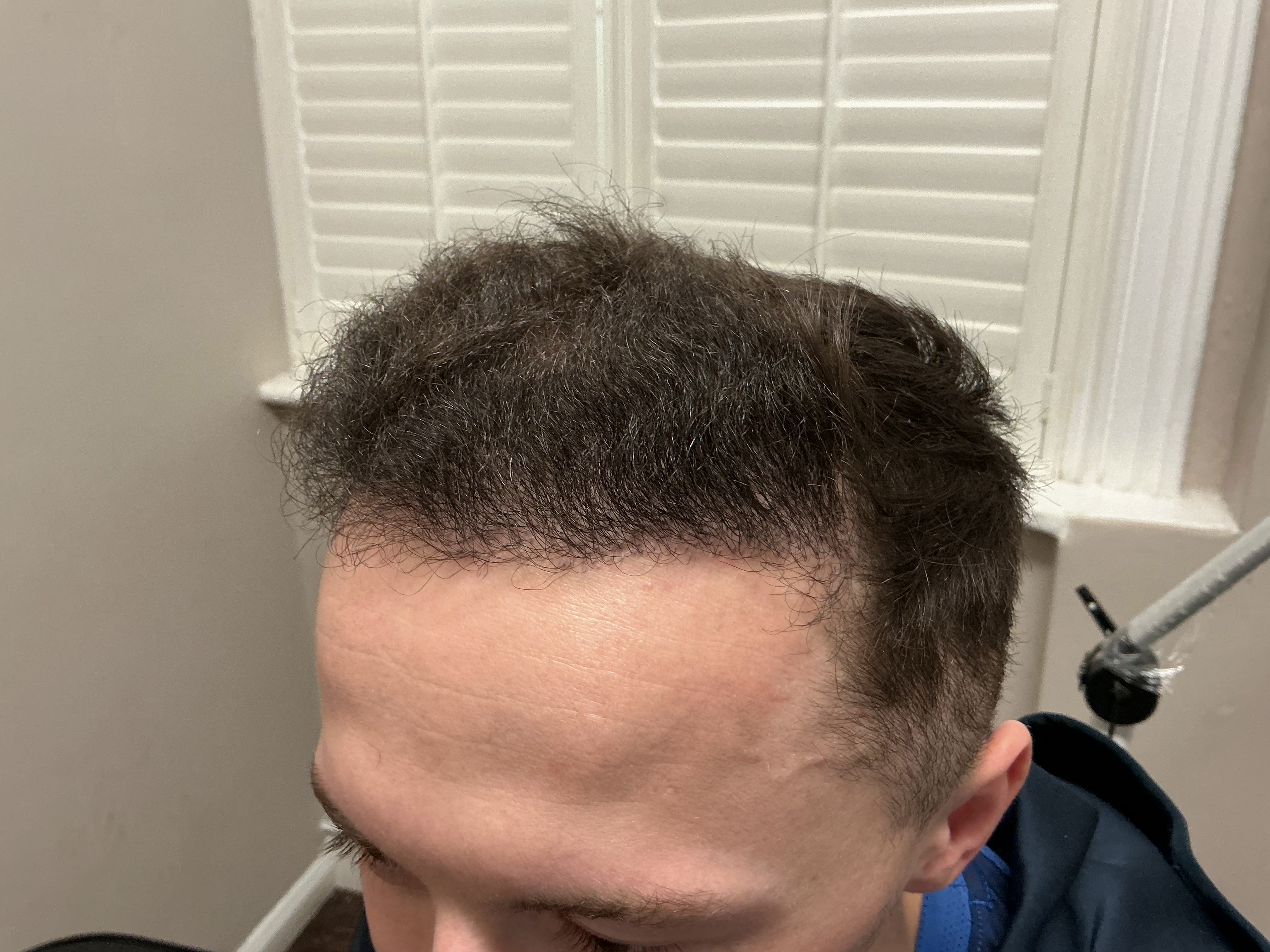 Advanced hairline recession — result photo 11